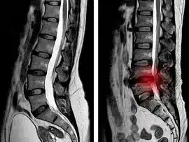 mri-lumbar-spine-scan-sagittal-260nw-1258976230