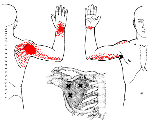 subscap+referred+pain